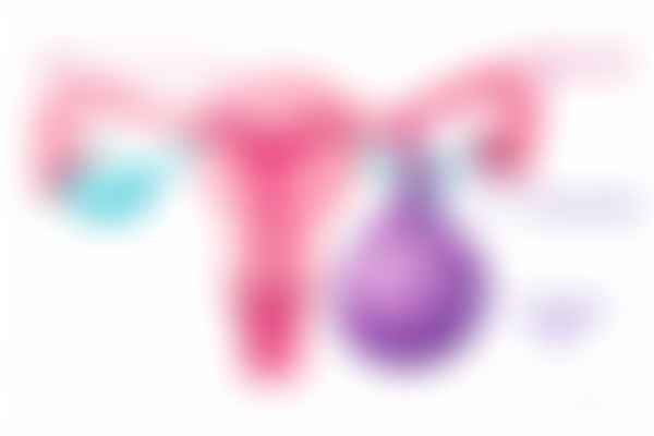 Ovarian torsion