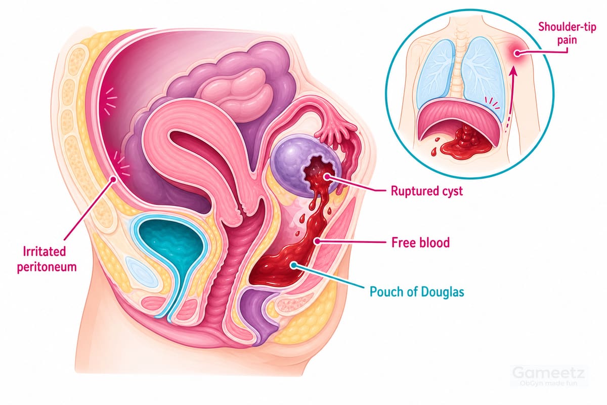 Ruptured ovarian cyst with haemoperitoneum