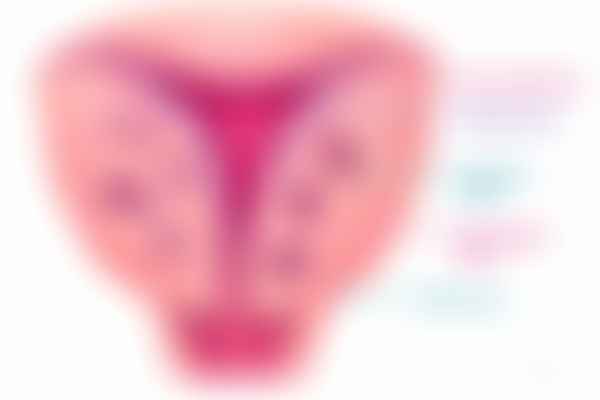 Adenomyosis pathophysiology showing basal endometrium invaginating through the junctional zone into hypertrophied myometrium