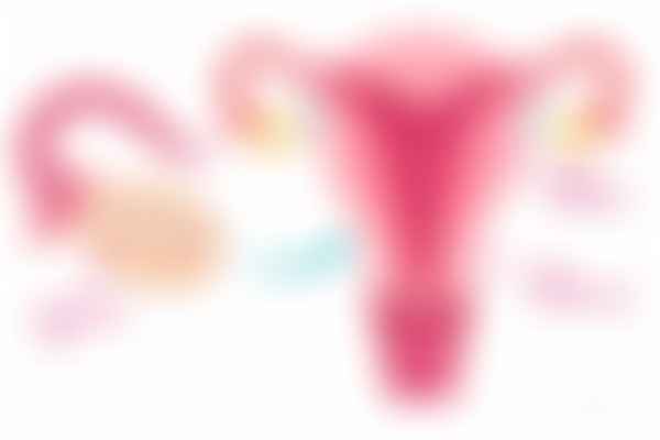 Anovulatory heavy bleeding with thick endometrium and patchy breakdown