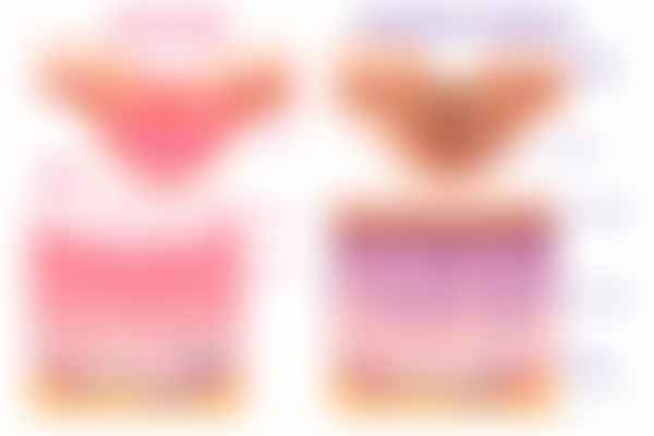Intertrigo and acanthosis nigricans in skin folds