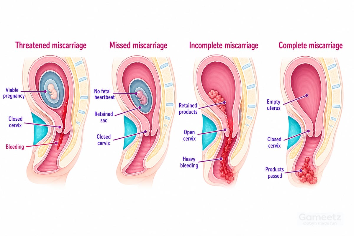 Early miscarriage classification: threatened, missed, incomplete, and complete miscarriage